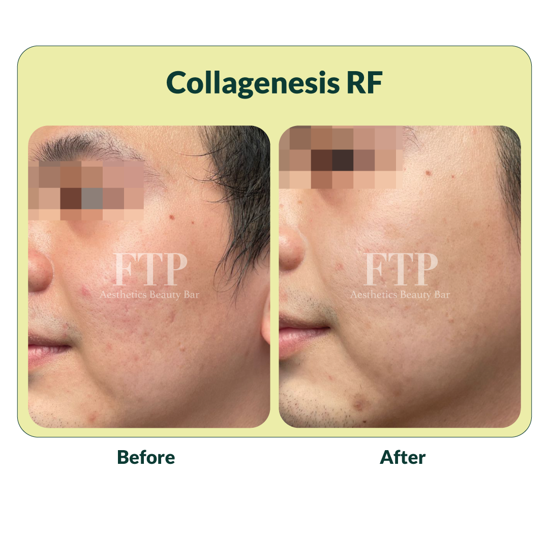 Before after Collagenesis RF