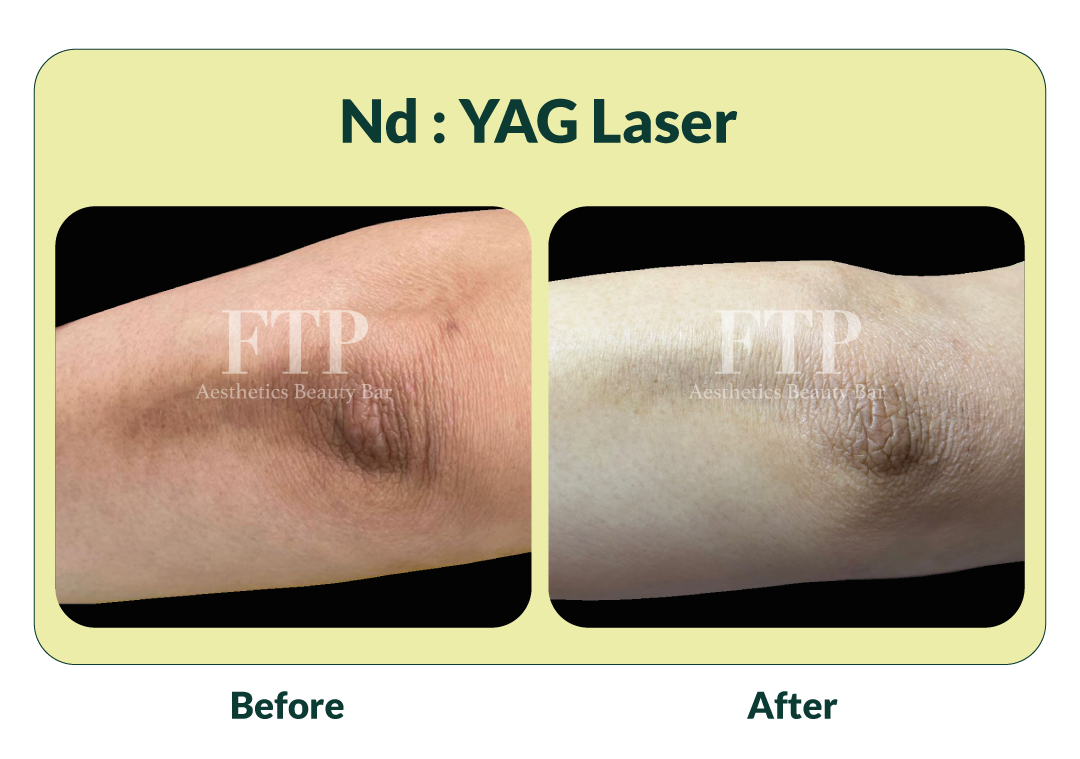Before after Nd : YAG Laser