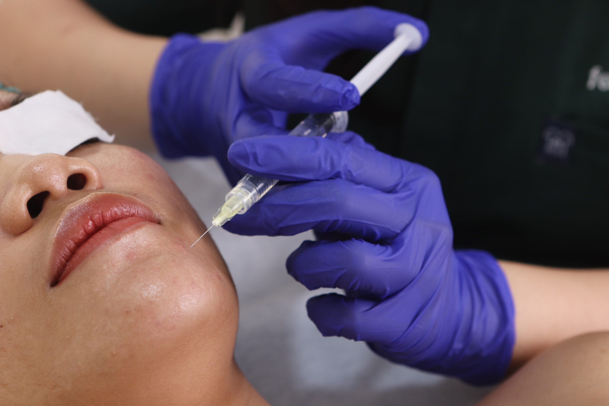 Botox Treatment
