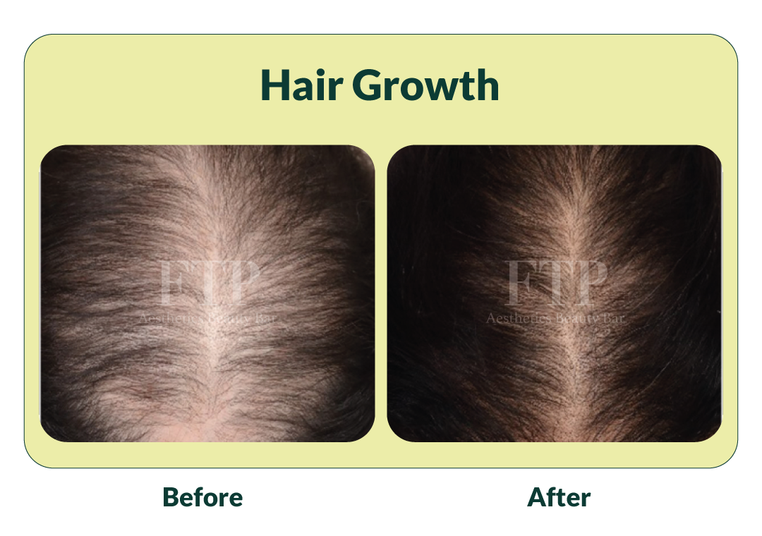 Hair growth