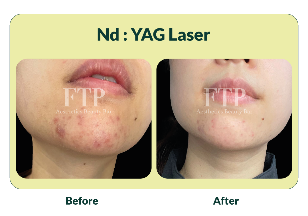 Before After Profhilo