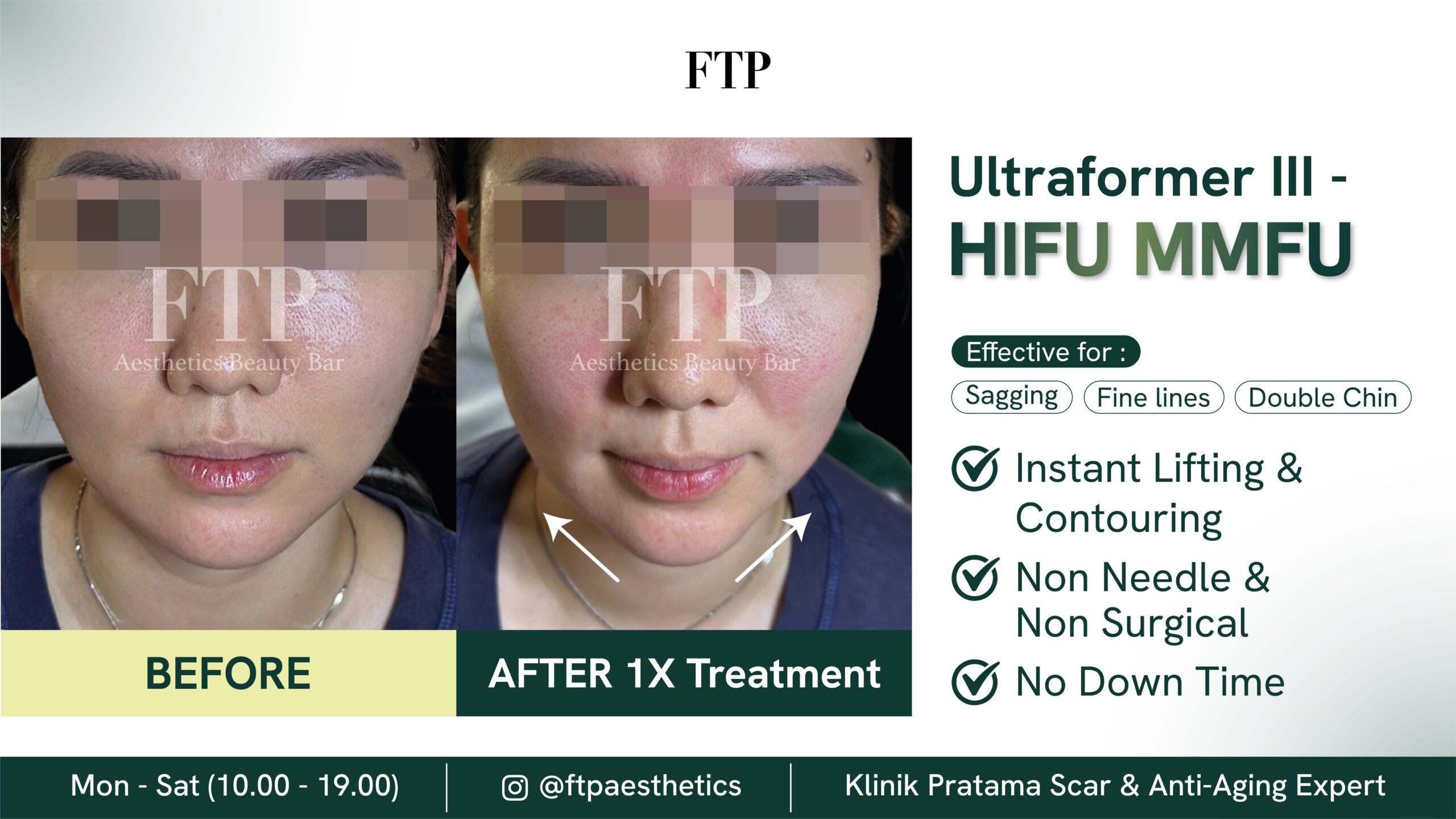 Before after HIFU