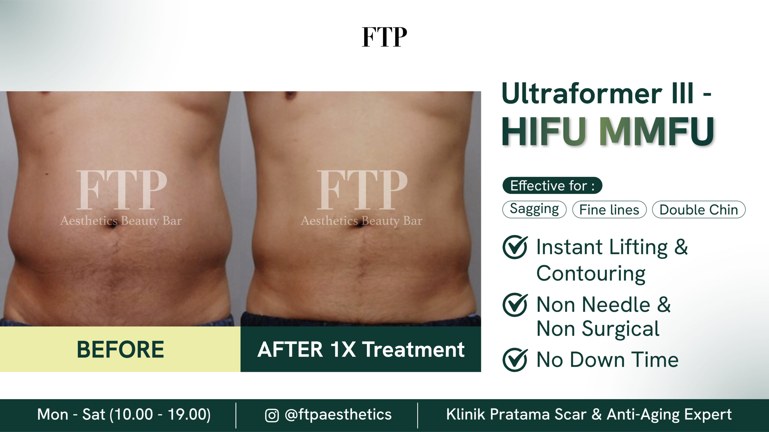 Before after HIFU