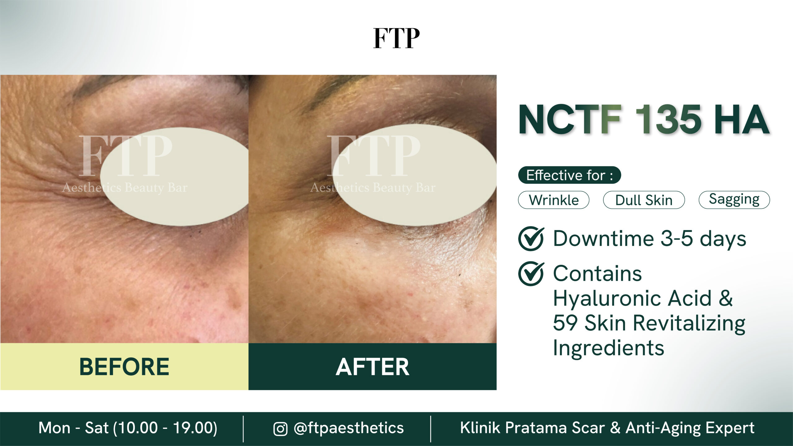 Before after NCTF 135 HA