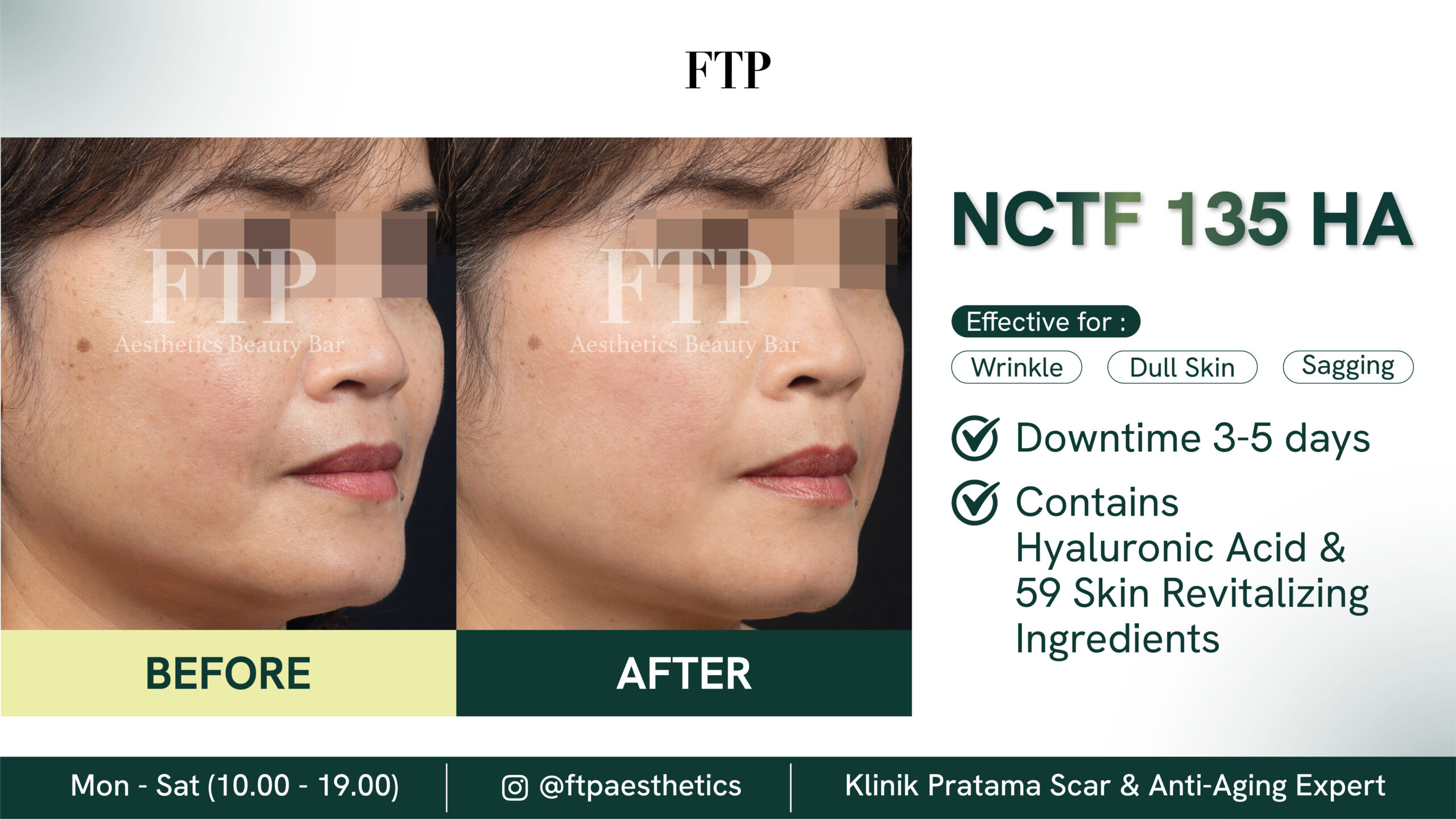 Before after NCTF 135 HA