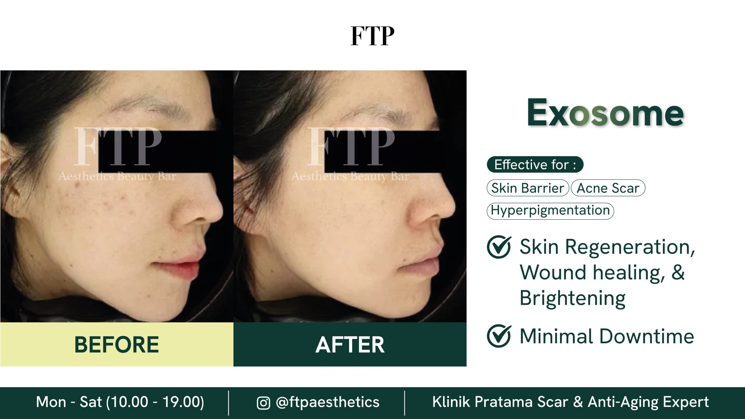 Before after exosome