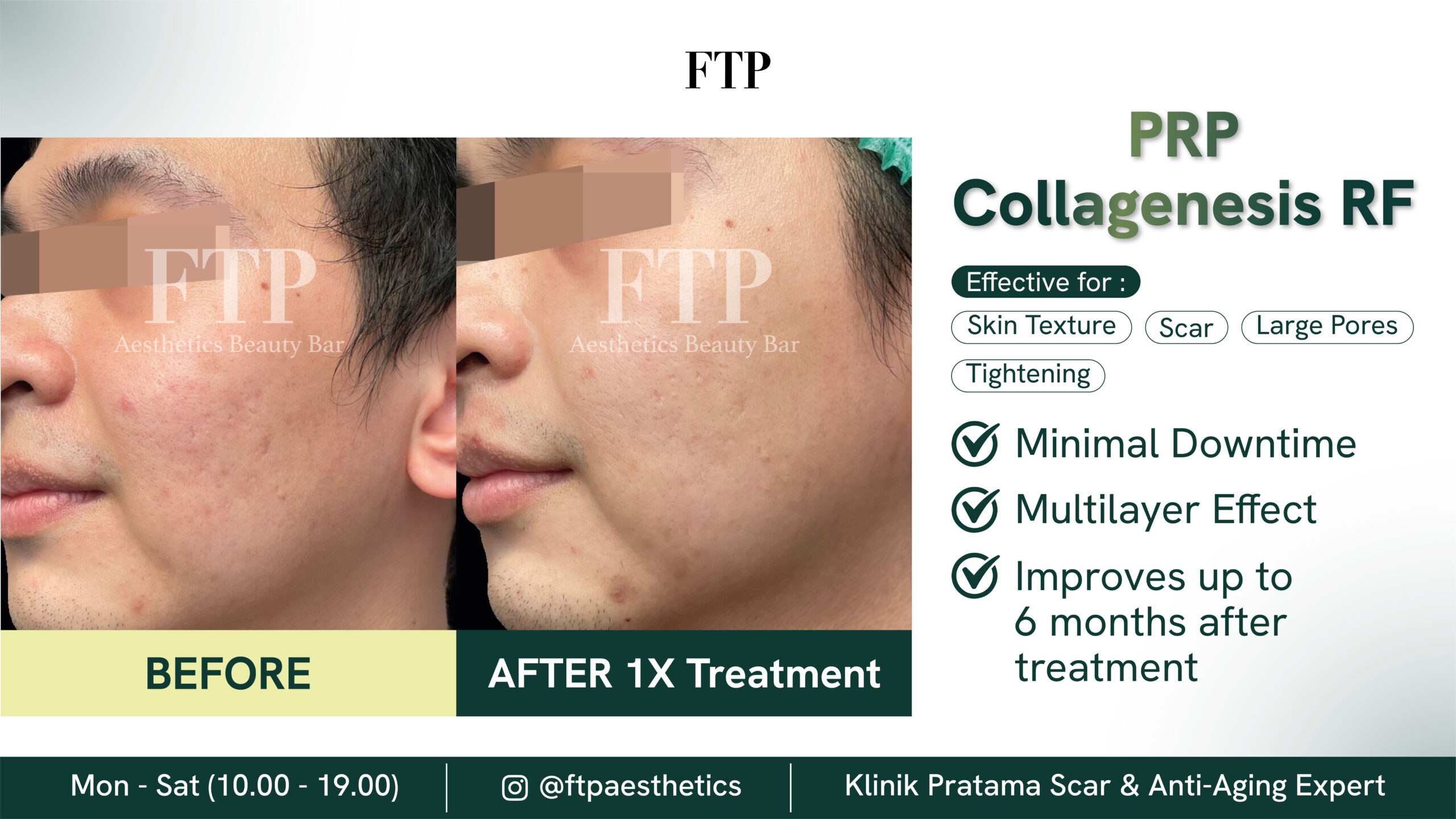Before after collagenesis RF