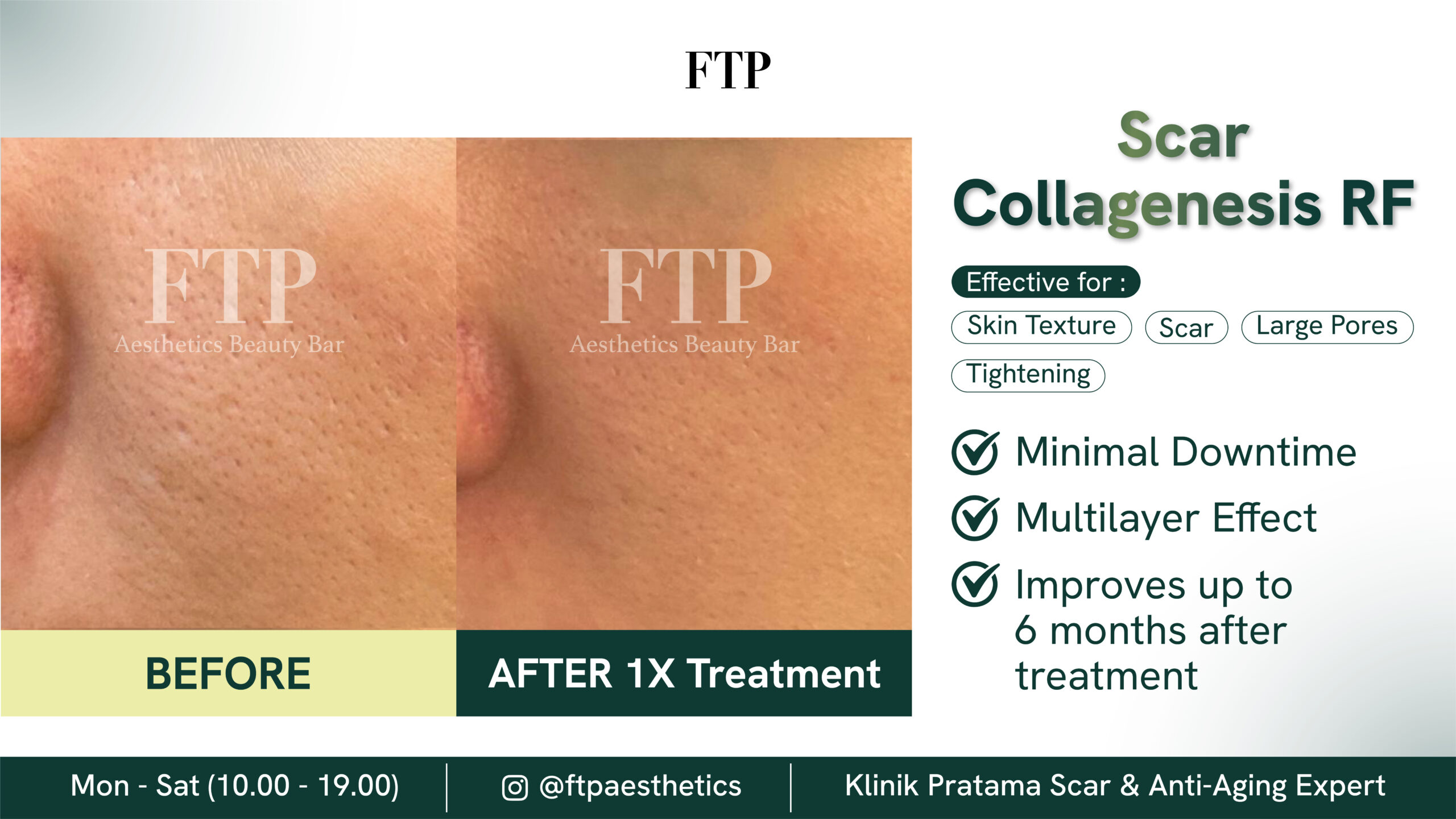 Before after collagenesis RF