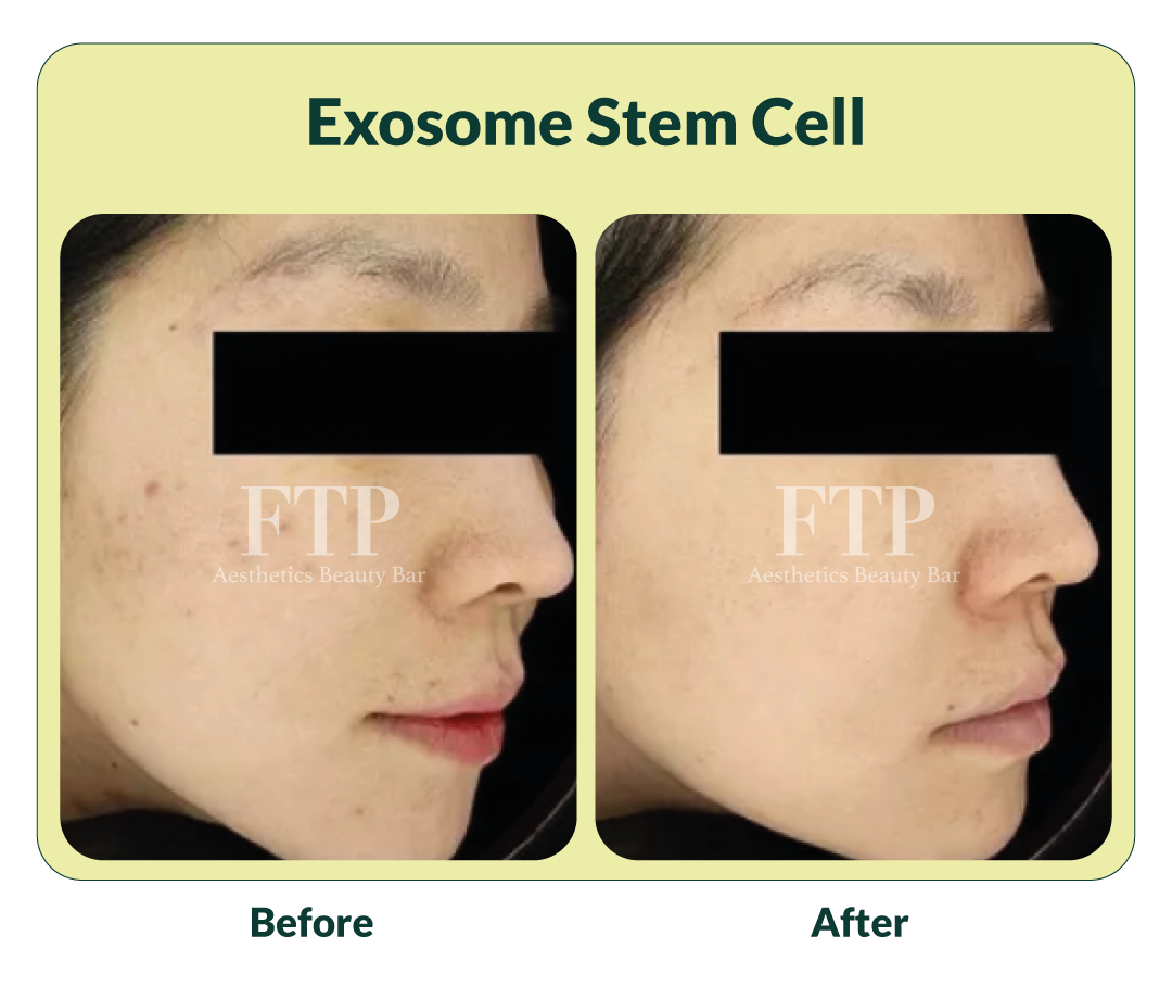 cara mengecilkan pori pori besar di wajah