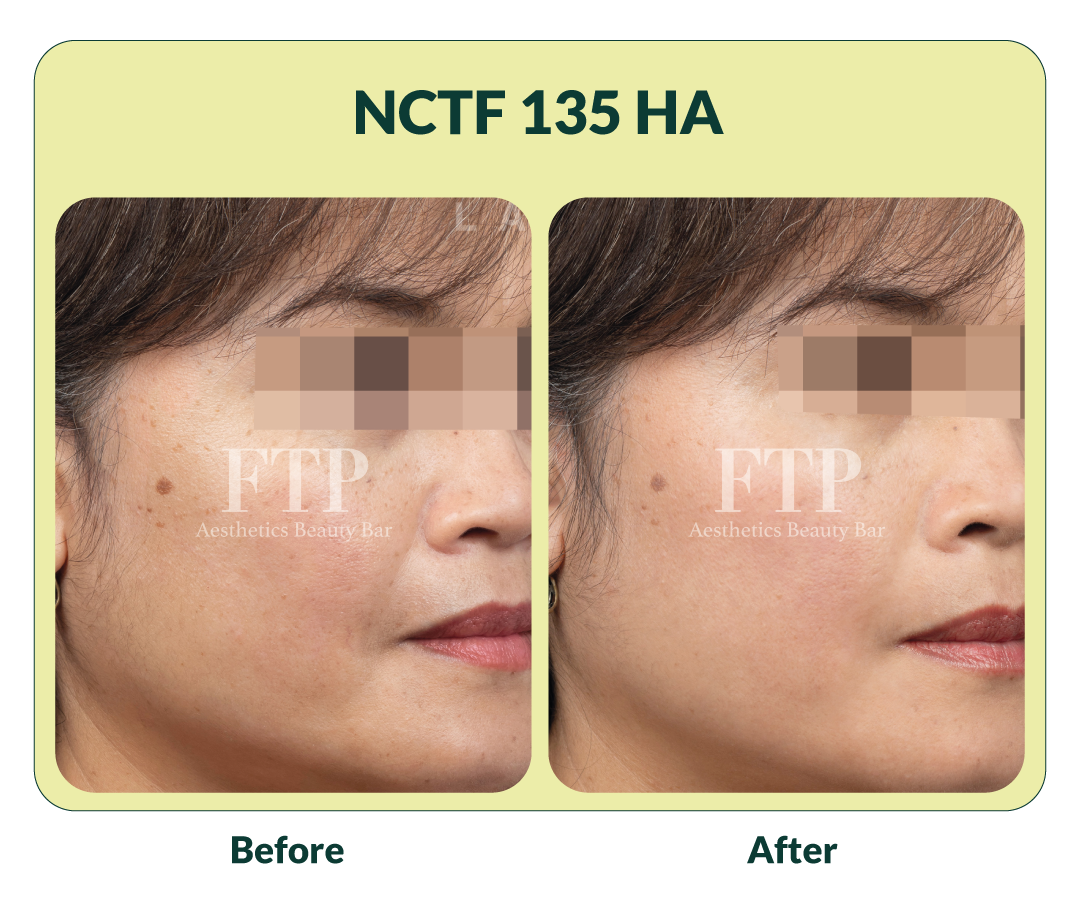 glass skin treatment