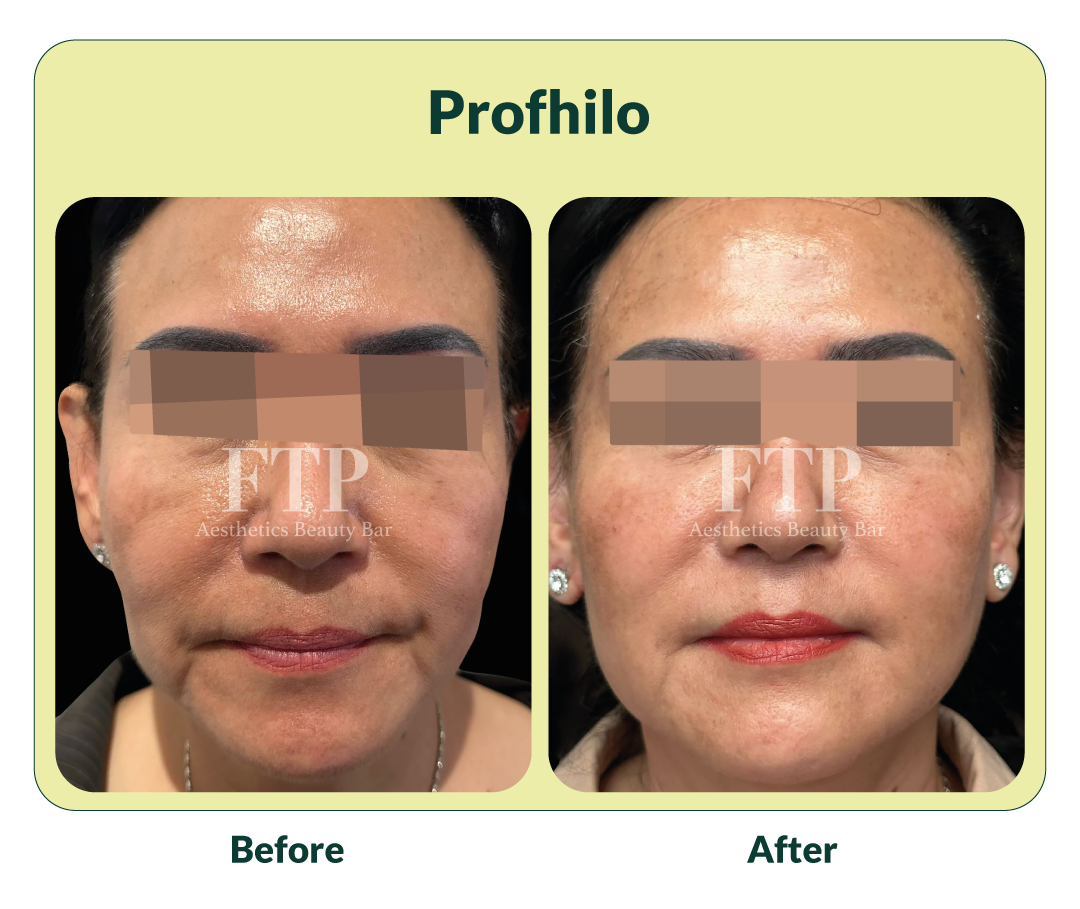 Before after Profhilo