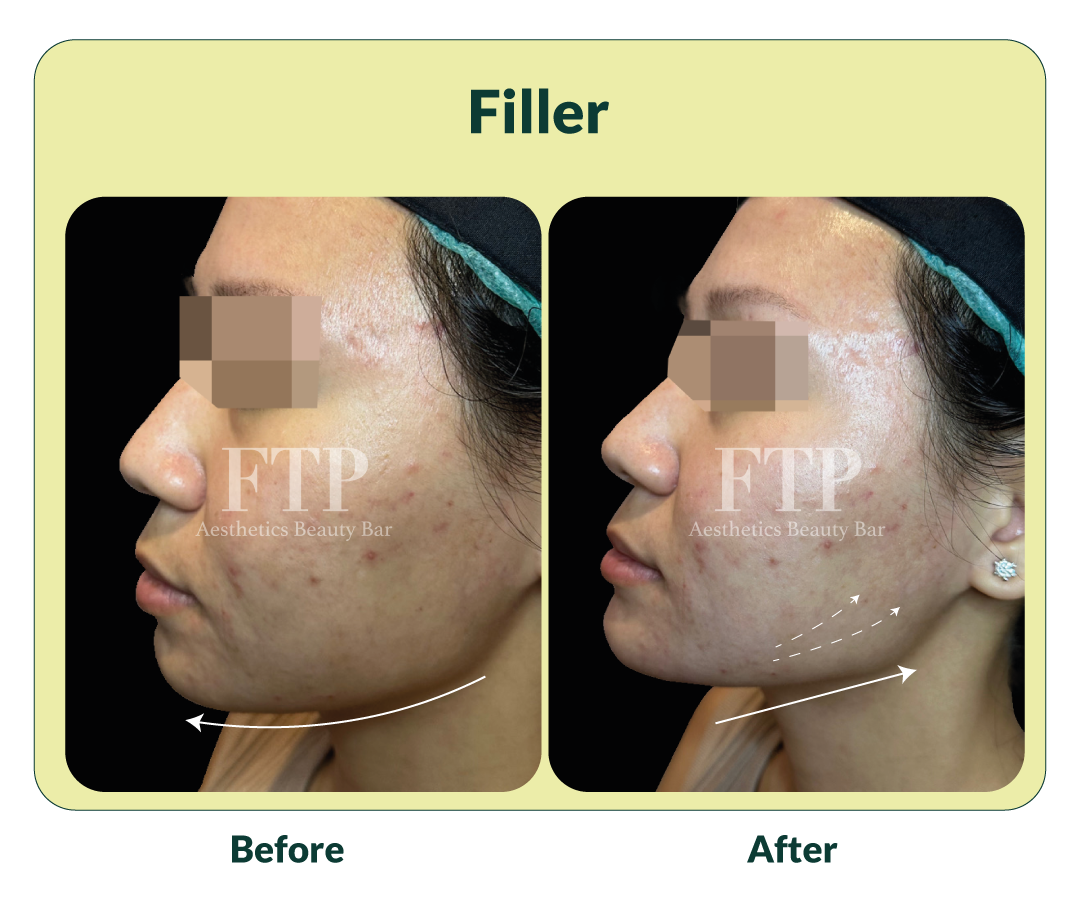 Before after filler