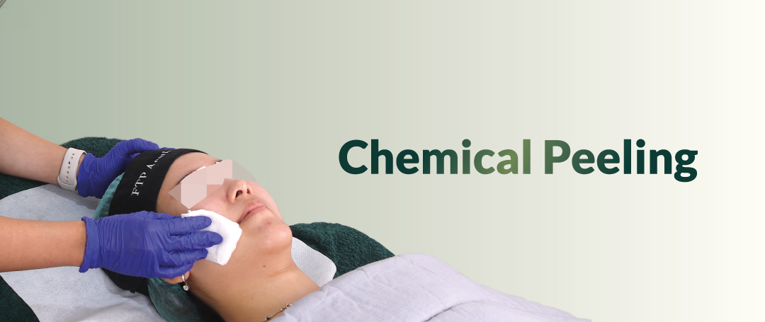 Chemical Peeling