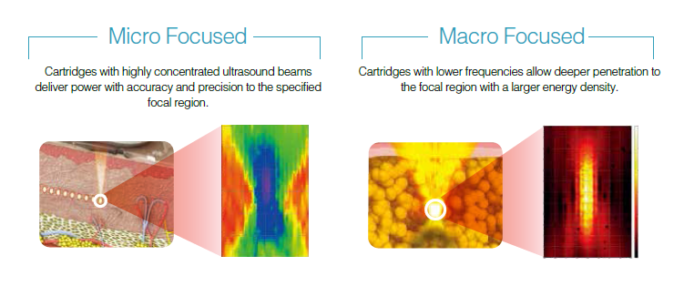 Ultraformer Micro Macro Focused