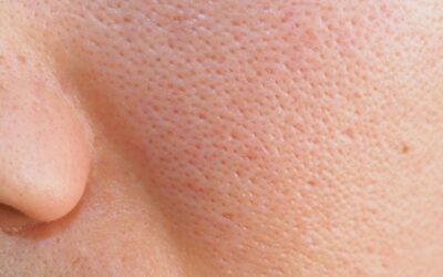4 Penyebab Pori-Pori Besar dan Cara Mengatasinya