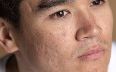 3 Treatment Efektif untuk Mengatasi Bopeng Membandel!