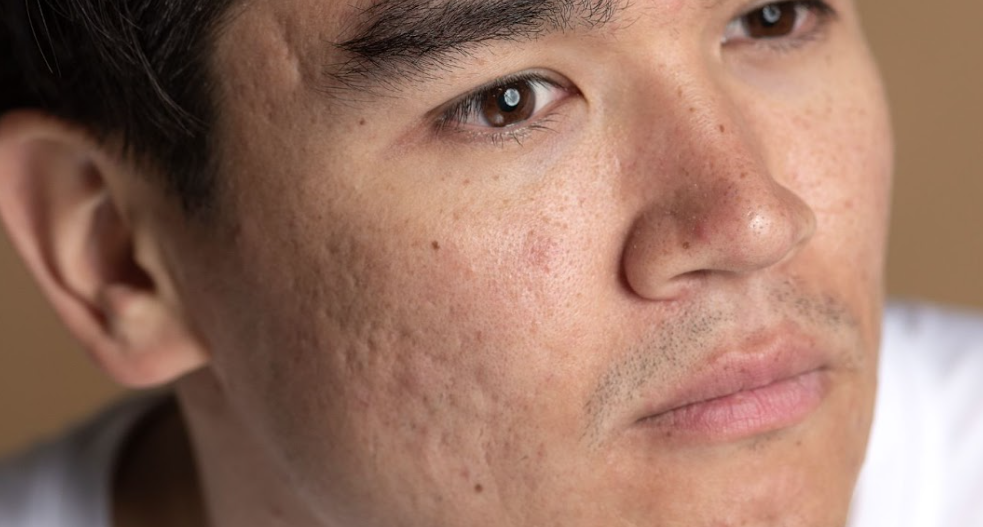 3 Treatment Efektif untuk Mengatasi Bopeng Membandel!