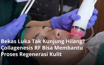 Bekas Luka Tak Kunjung Hilang? Collagenesis RF Bisa Membantu Proses Regenerasi Kulit