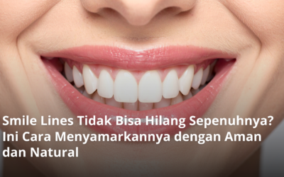 Smile Lines Tidak Bisa Hilang Sepenuhnya? Ini Cara Menyamarkannya dengan Aman & Natural