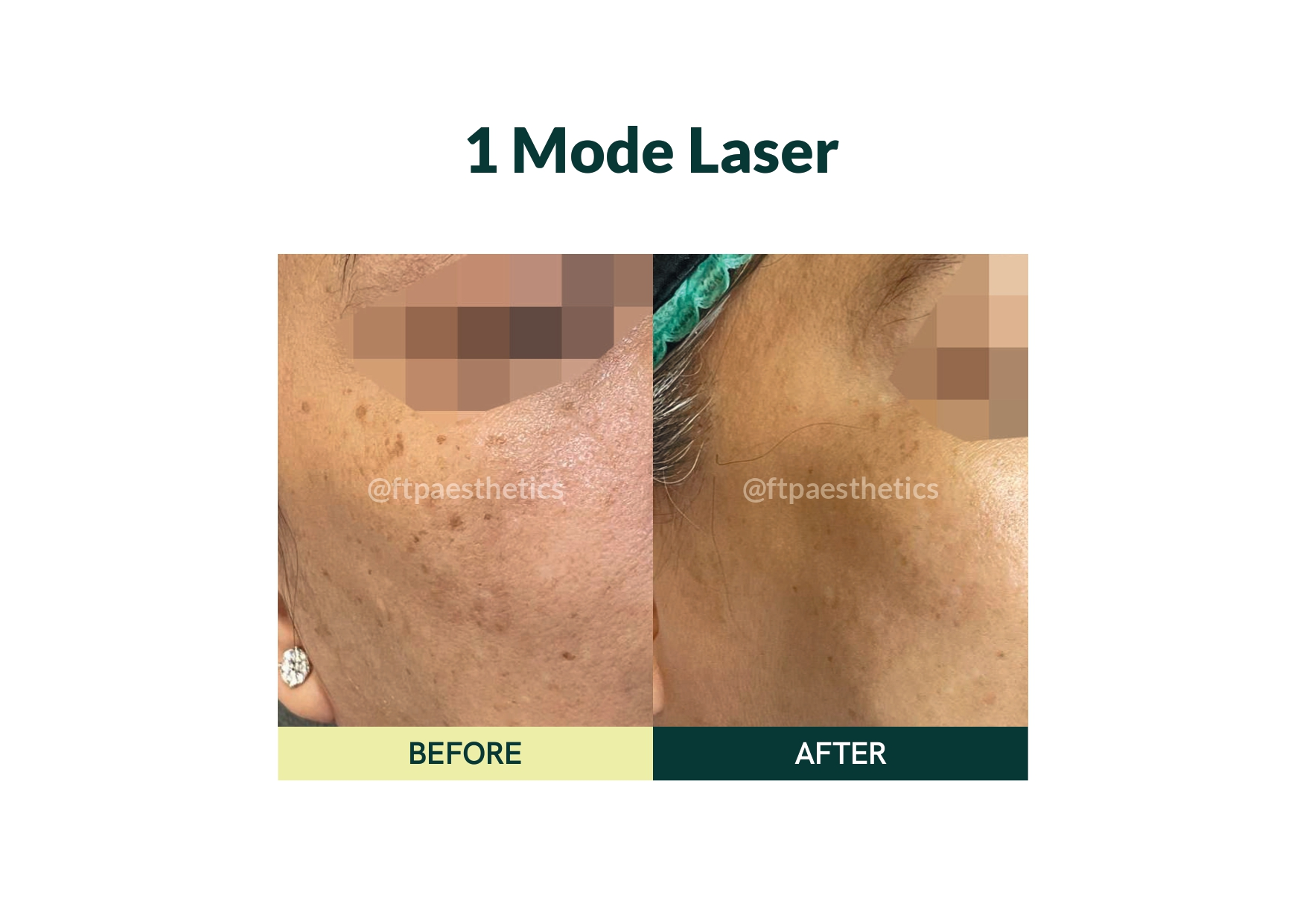laser