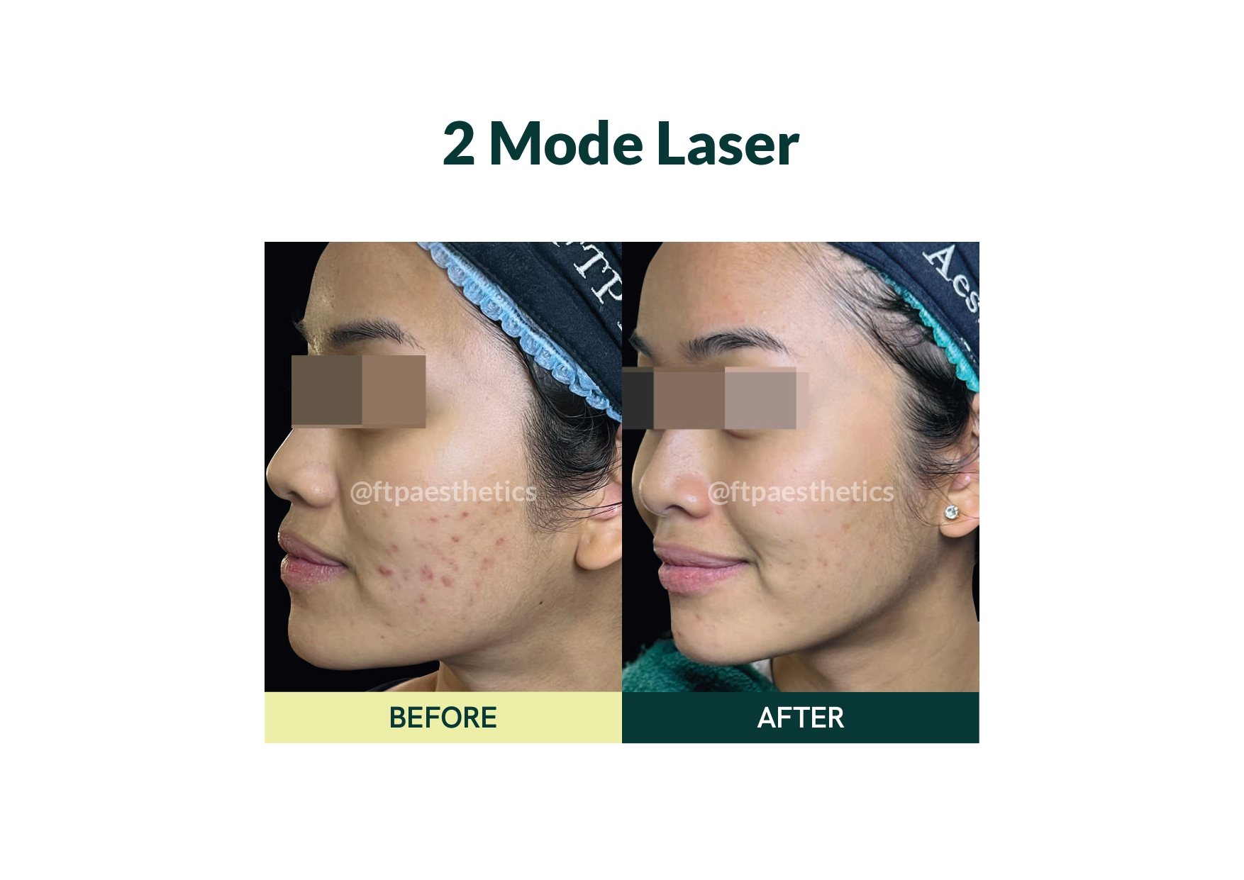 laser
